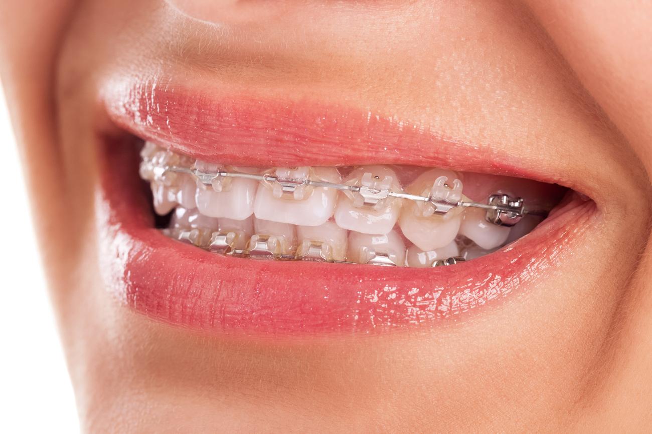 Ceramic braces