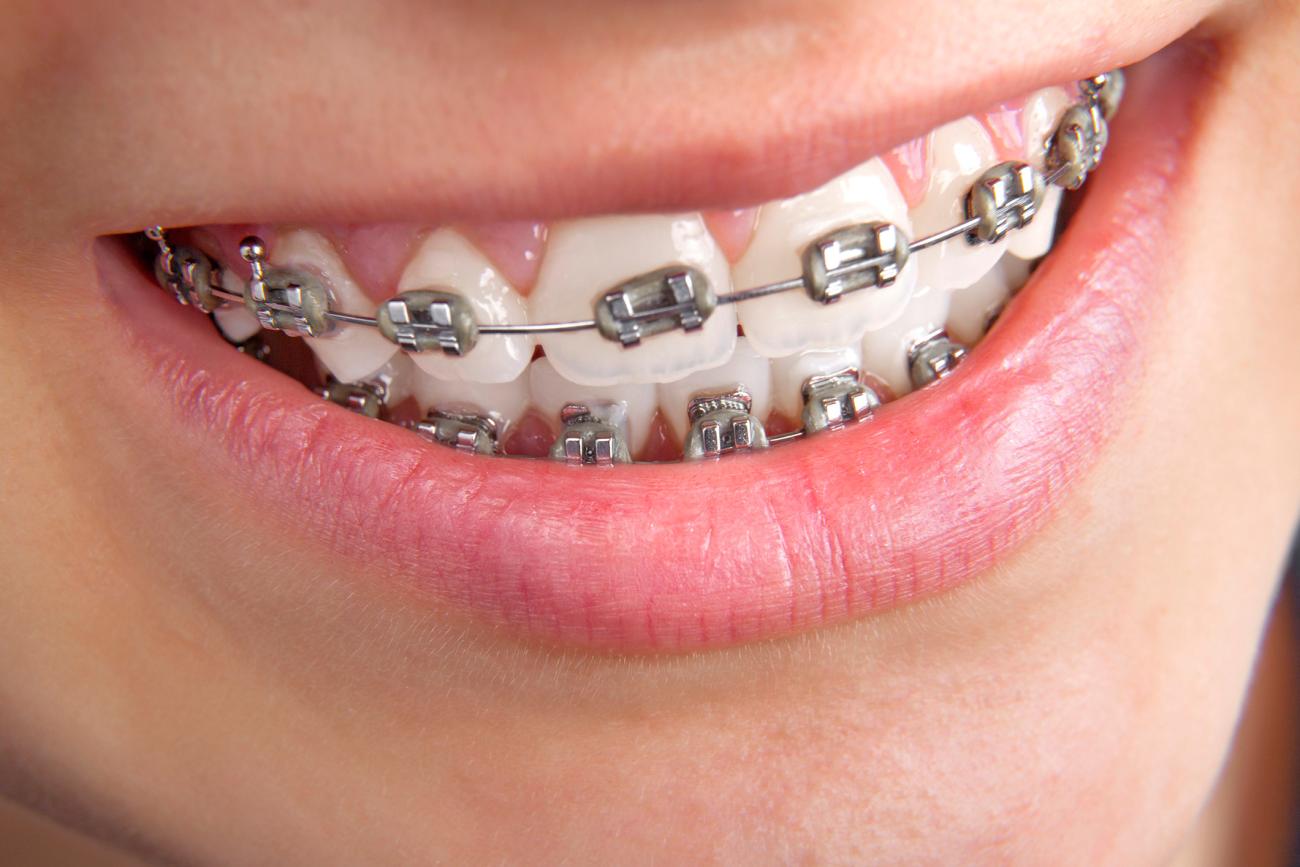 Braces