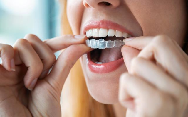 Invisalign aligner